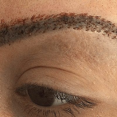 Hair-Transplant-in-Turkey-1