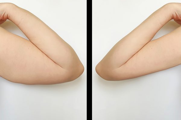 Nadlaktica-primer-2a