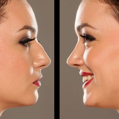 Operacija-nosa-Tamara-Čolak-1024x683