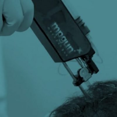 prp-treatment-for-hair-loss-scaled-1